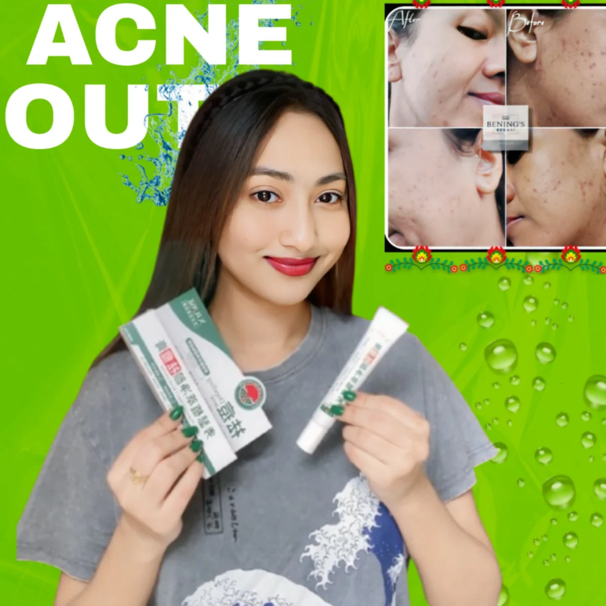 Xluse Plant Extract Acne Cream and Sadoer Tea Tree Acne Gel combo pack for acne treatment, oil control, and scar removal.
